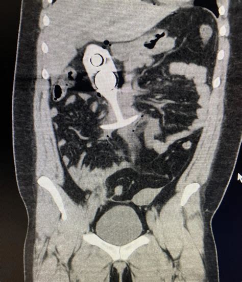 metal butt plug mri|mri to ct video.